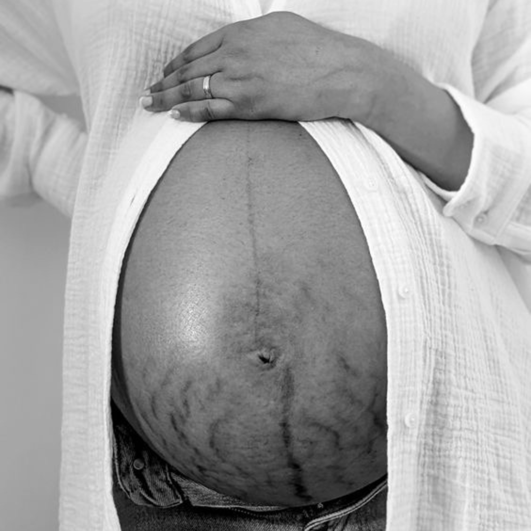 Vergetures de grossesse: pourquoi j'ai des vergetures enceinte ?